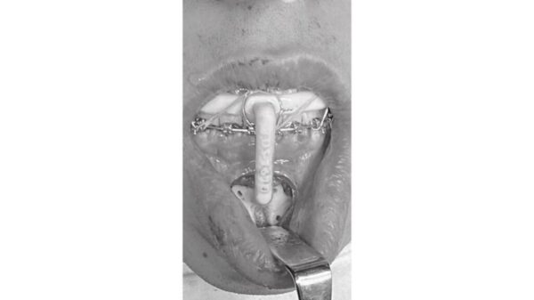 Osteotomía Mentón Osteotomía Mentón