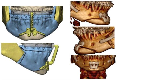 Osteotomía de Mentón Osteotomía de Mentón