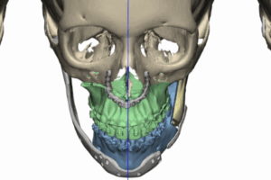 SUPERPOSICIÓN TOMOGRAFÍA POSTQUIRÚRGICA & PLANIFICACIÓN VIRTUAL